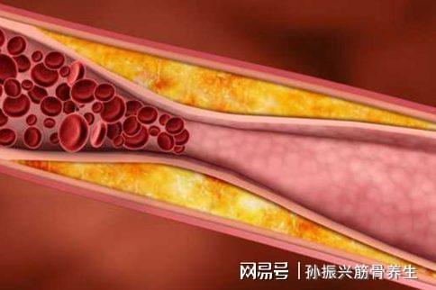 袭三大诱因需警惕！m6米乐脑梗二次来